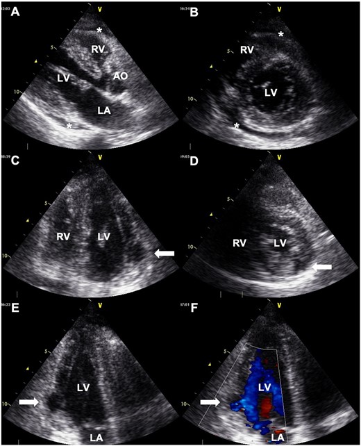 Transthoracic echocardiography showing mild pericardial effusion (*), and an aneurysmal cavity located at the basal-inferolateral left ventricle (LV) (white arrows). (A) Long-axis view. (B) Short-axis view at the chordae level. (C) Apical four-chamber view. (D) Short-axis view at the papillary muscle level. (E) Apical three-chamber view. (F) Doppler colour flow imaging of apical three-chamber view showing blood flow within an aneurysmal cavity. AO, aorta; LA, left atrium; RV, right ventricle.