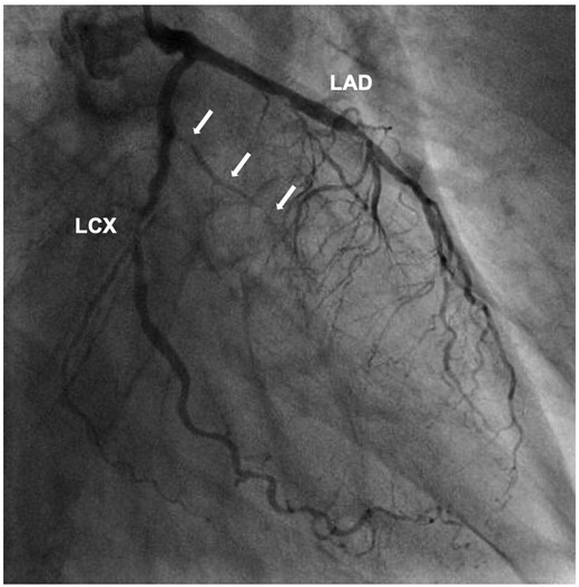 Coronary angiography of left coronary artery showing a narrowed first obtuse marginal branch with coronary slow flow (white arrows). LAD, left anterior descending artery; LCX, left circumflex artery.