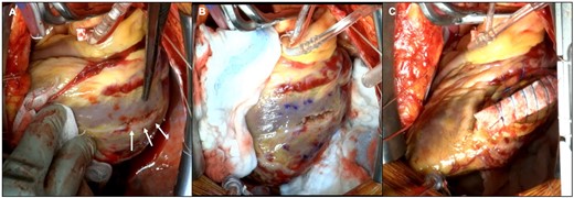 Intraoperative images. (A) The aneurysmal cavity and pericardial space were separated by the layer of a thinning myocardium with a small line wound (white arrows). (B) After incising the wound from the outside, the connection between the aneurysm and the cardiac lumen through a narrow orifice was confirmed. (C) The left ventricle was sutured and fixed by surgical glue.