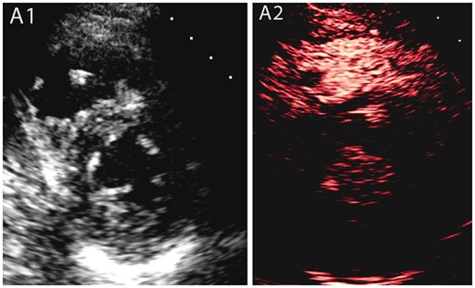 Case 1: A male coronavirus disease 2019 patient who had a previous pulmonary embolism with a suspected right ventricular thrombus in the non-enhanced study, which was subsequently confirmed by contrast echocardiography. (A1) Parasternal short axis view shows a small right ventricular mass, (A2) contrast echocardiography of the same view, showing a non-perfused right ventricular mass suggestive of thrombus.