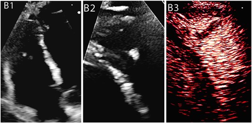 Case 2: A male COVID-19 patient with lymphoma on chemotherapy. Non-contrast study showed a dilated and dysfunctional RV with elevated PVR and a suspected RV thrombus which was identified as RV trabeculation on CE. (B1) Non-enhanced image of a dilated and dysfunctional RV, (B2) Non-enhanced image of RV modified view displays an apical mass, (B3) CE of RV modified view demonstrates no evidence of mass but a conglomerate of trabeculation with contrast noted between the trabeculae.