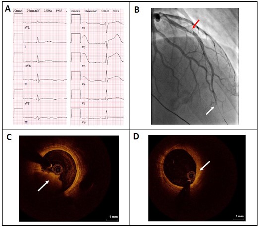 Electrocardiogram, angiography, and optical coherence tomography images before intervention. (A) Twelve-lead electrocardiography in ER showing ST-elevations in leads V1–V4 compatible with anteroseptal ST-segment elevation myocardial infarction. (B) Coronary angiography in right anterior oblique view with red arrow indicating partial occlusion in mid-left anterior descending artery and white arrow indicating total occlusion in the distal part of left anterior descending artery. Intracoronary optical coherence tomography imaging during second coronary intervention with arrows indicating red thrombus (C) and fibroatheroma (D) in left anterior descending artery.
