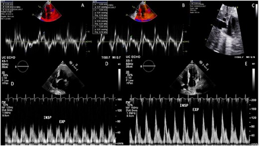 Patient A echocardiography. (A) Lateral annulus tissue Doppler with normal value. (B) Septal annulus tissue Doppler with normal value. (C) Inferior vena cava showing dilation. (D) Pulse wave Doppler tricuspid inflow with inconclusive respiratory variation. (E) Pulse wave Doppler mitral inflow with inconclusive respiratory variation.