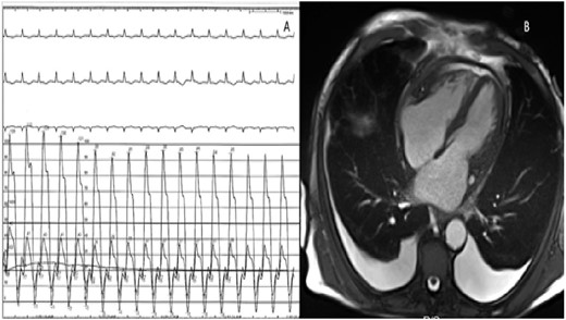 (A) Invasive haemodynamic measurement of right and left ventricular pressure with inconclusive interventricular interdependence. (B) Four-chamber cardiac magnetic resonance imaging image demonstrating moderate pericardial effusion and thickening of the pericardium.