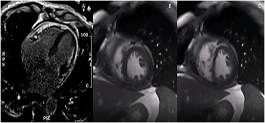 Patient A cardiac magnetic resonance imaging. (A) Four-chamber delayed gadolinium image with diffuse pericardial enhancement and thickening. (B) Two-chamber free-breathing sequence in expiration with exaggerated rightward shift of the interventricular septum. (C) Two-chamber free-breathing sequence in inspiration with exaggerated leftward shift of the interventricular septum.