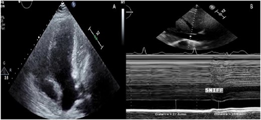 Patient B echocardiography. (A) Apical four-chamber image showing a mass compressing the lateral wall of the left ventricle. (B) M mode of the inferior vena cava showing dilation and blunted respiratory changes.