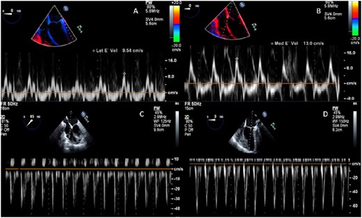 Patient B transoesophageal echocardiography. (A) Lateral annulus tissue Doppler with normal value. (B) Septal annulus tissue Doppler with normal value. (C) Pulse wave Doppler tricuspid inflow with inconclusive respiratory variation. (D) Pulse wave Doppler mitral inflow with inconclusive respiratory variation.