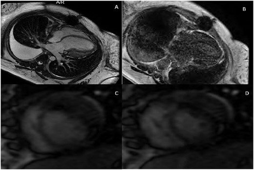 Patient B cardiac magnetic resonance imaging. (A) Four-chamber cardiac magnetic resonance imaging image showing a loculated pericardial effusion compressing the lateral wall of the left ventricle. (B) Four-chamber delayed gadolinium image with diffuse pericardial enhancement and thickening. (C) Two-chamber free-breathing sequence in expiration with exaggerated rightward shift of the interventricular septum. (D) Two-chamber free-breathing sequence in inspiration with exaggerated leftward shift of the interventricular septum.