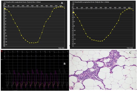 (A) Left pane: left ventricular strain analysis with normal pattern. Right pane: right ventricular strain analysis with normal pattern. (B) Invasive haemodynamic measurement of right and left ventricular pressure with interventricular interdependence. (C) Surgical pathology of the excised pericardium with fibrosis and caseous inflammatory material.