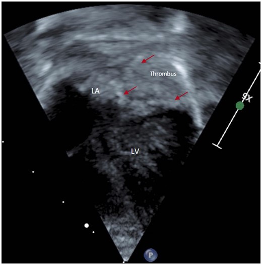 Contrast entering left atrium superior to echogenic mass, smooth lined left atrial wall delineated (red arrows) before it drains to left ventricle. LA, left atrium; LV, left ventricle.