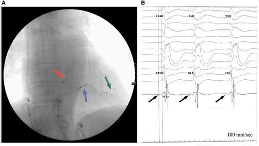 Outcomes after lead placement. (A) Final leads position according to anteroposterior projection fluoroscopy: in His bundle area (red arrow); in the middle third of interventricular septal (blue arrow); in the posterior vein of left ventricular (green arrow). (B) Potentials recorded from the His bundle (arrows) during implantation, H-V conduction time—67 ms.
