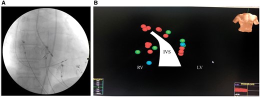 Atrioventricular nodal radiofrequency ablation. (A) Fluoroscopic view at the point of successful repeated radiofrequency ablation. (B) 3D cardiac mapping results: red spheres—repeated radiofrequency ablation applications; green—elements of conduction system; blue—zones of His bundle pacing lead projections. IVS, interventricular septal; LV, left ventricular; RV, right ventricular.