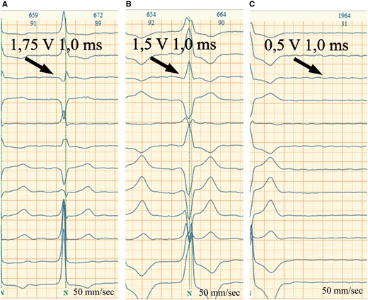 His bundle pacing lead thresholds test. (A) His bundle capture with correction of underlying right bundle branch block (1.75 V). (B) Right ventricular capture (1.5 V). (C) Loss of capture (0.5 V).