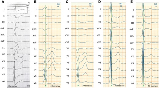 Electrocardiogram in different pacing modalities. (A) Native electrocardiogram; (B) right ventricular stimulation; (C) simultaneous biventricular stimulation; (D) His bundle pacing; (E) His bundle pacing fusion with left ventricular epicardial pacing.