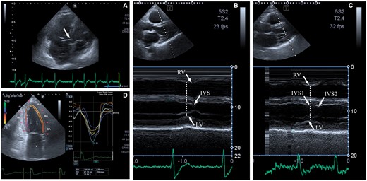 EchoCG. (A) His bundle pacing lead visualization; (B) M-mode—parasternal long-axis view—native rhythm, delay of right ventricular, and interventricular septal contraction peaks relatively to the left ventricular posterior wall. (C) M-mode parasternal long-axis view—pacing with the synchronicity and gaining of wall motion (interventricular septal 1—first peak and interventricular septal 2—second peak as signs of residual minor left ventricular dyssynchrony). IVS, interventricular septal; LV, left ventricular; RV, right ventricular.