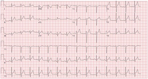 Electrocardiogram at presentation. Initial electrocardiogram in emergency department showing ST-segment elevations in the lateral limb and all precordial leads except V1. These changes were new compared to a prior electrocardiogram done 6 years earlier.