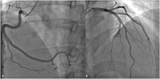 Coronary angiogram. Coronary angiogram of the normal right coronary artery (A) and left coronary artery (B) showing mild focal non-obstructive disease in the mid-left anterior descending artery.
