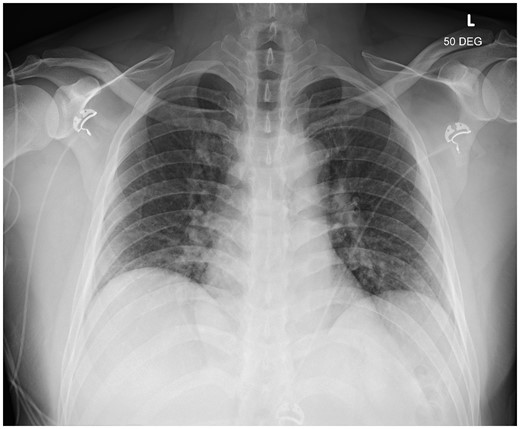 Chest X-ray. Chest X-ray of the patient showing mild pulmonary oedema.