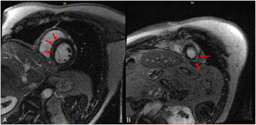 Cardiac magnetic resonance imaging. Cardiac magnetic resonance imaging showing linear mid-myocardial late gadolinium enhancement of the septum and inferior walls at the base to mid-ventricle (A) and sub-epicardial/mid-myocardial enhancement of the apical lateral wall (B).
