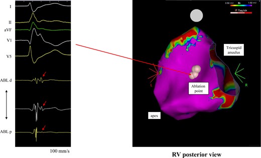The voltage map of the right ventricle during the triggering ventricular premature contraction ablation. The pink points indicate the ablation sites where delayed potentials were observed. ABL, ablation catheter.