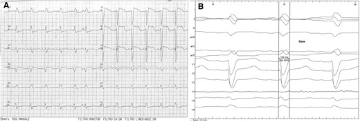 Baseline 12-lead EKG. (A) Standard recording, showing sinus rhythm and complete left bundle branch block; (B) recording in the lab at 100 mm/s, showing QRS duration and morphology.