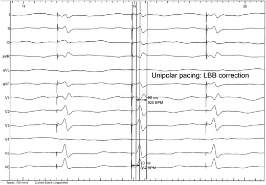 Left bundle branch capture during lead positioning: rSR’ complex in V1 lead with narrowed QRS and rapid intrinsecoid deflection in V6.