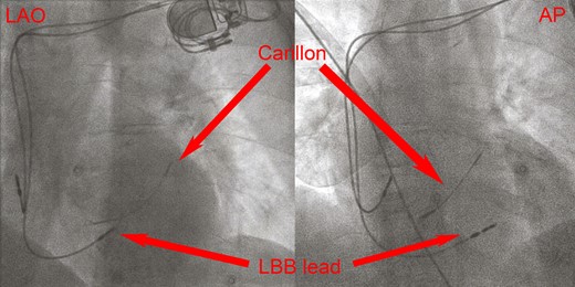 Left anterior oblique and antero–posterior fluoroscopy of the implanted lead. Note the ventricular lead (left bundle branch lead) pointing through the myocardium of the mid septum and the Carillon device placed in the coronary sinus.