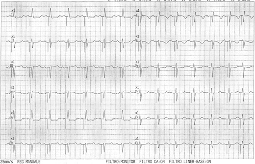 Twelve-lead EKG with left bundle branch pacing and narrow, near-normal, QRS duration.