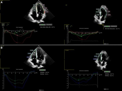 Strain curves of the left (panel A) and right (panel B) ventricle before and 2 months after LLBP, showing recovering in mechanical synchrony.