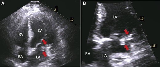 Transthoracic echocardiography showing masses over mitral annulus calcification. (A) Four-chamber apical view shows at least two echogenic masses (arrows) over calcified posterior mitral leaflet. (B) Zoomed four-chamber apical view showing more closely the aforementioned masses (arrows). LV, left ventricle; LA, left atrium; RV, right ventricle; RA, right atrium.