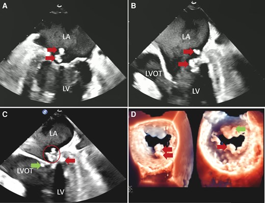 Transoesophageal echocardiography of the mitral valve masses. (A) Mid-oesophageal two-chamber view shows two echogenic masses (arrows) on the atrial side of the calcified posterior mitral leaflet. (B) Mid-oesophageal three-chamber view shows these masses (arrows) are highly mobile projecting into both the left atrium and left ventricle. (C) Mid-oesophageal three-chamber view shows there are additional masses on the ventricular side of the posterior (arrow on right side of the image) and anterior (arrow on left side of the image) leaflets. Note one of the masses (circled) has a mixture of high- and low-density areas suggesting caseous calcification of the mitral annulus. (D) 3-D images of the atrial (left) and ventricular (right) sides of the mitral valve also demonstrating the masses.