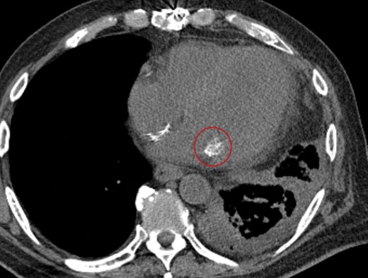 Noncontrast computed tomography scan of the chest shows caseous calcification of the mitral annulus. Axial view shows that at least one of the masses (circled) on the posterior mitral annulus appeared calcified with a mixture of high- and low-density areas suggesting caseous calcification of the mitral annulus.