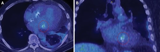 18F-fluorodeoxyglucose–positron emission tomography–computed tomography scan showing uptake along a portion of mitral annulus. Shows activity (circled) along a portion of the calcified mitral annulus suggesting possible infective endocarditis in the axial view (A) and coronal view (B).
