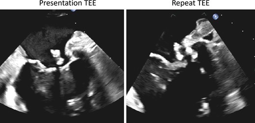 Follow-up transoesophageal echocardiography of the mitral masses. On follow-up transoesophageal echocardiography (right panel) after completion of 6-week course of antibiotics, the mitral masses were found to be of similar size compared with the baseline transoesophageal echocardiography (left panel).