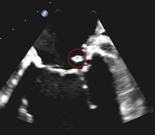 Follow-up transoesophageal echocardiography of the mitral masses suggests persisting caseous calcification of the mitral annulus. Note the previous mass which had has a mixture of high- and low-density areas suggesting caseous calcification of the mitral annulus still has heterogenicity.