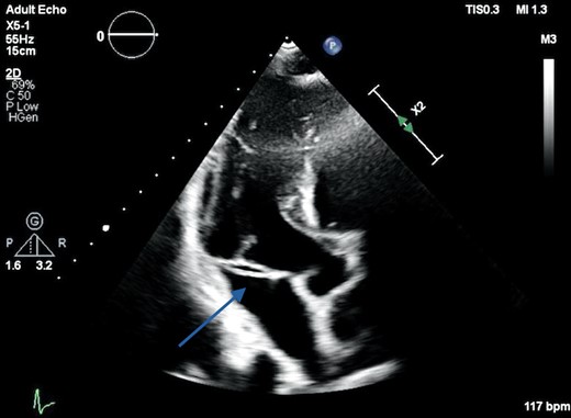 Transthoracic echocardiography apical three-chamber view demonstrating a linear echogenic structure in the region of the mitral annulus measuring 23 mm in length in the anteroposterior plane (arrow).
