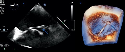 (A) Two-dimensional transoesophageal echocardiographic view of the mitral fibrous band in the horizontal mid-oesophageal plane showing an attachment at the base of the anterior mitral valve leaflet (arrow). (B) Three-dimensional reconstruction of the mitral valve in the ‘surgeon’s view’ shows the band in its entirety measuring 23 mm in length, running perpendicular to the commissural line from the posterior mitral annulus to the base of the middle scallop of the anterior leaflet (arrows).