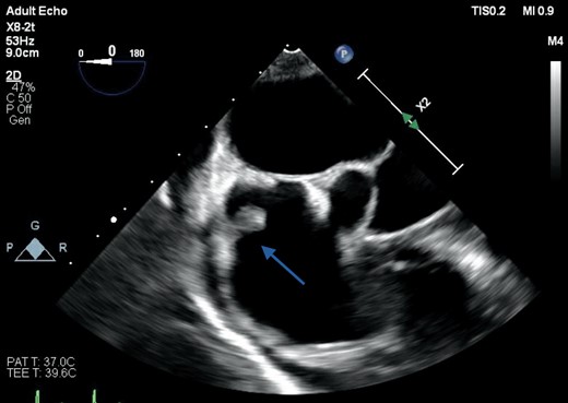 Transoesophageal echocardiography of both atria and the interatrial septum, showing a sessile soft tissue mass attached to the roof of the right atrium measuring 1 cm in maximum length and consistent with a thrombus (arrow).