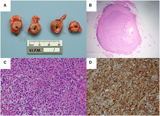 (A) Cross-sections of the proximal left anterior descending coronary artery demonstrate infiltration by firm, pale tissue atypical for atherosclerotic plaque. (B) There is near-complete luminal occlusion. (C) Haematoxylin and eosin staining identifies a florid and extensive infiltrate of plasma cells that extend from the tunica adventitia to the media. (D) IgG4 immunostaining demonstrates that a high proportion of these cells are IgG4+.