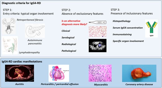 The American College of Rheumatology and European League Against Rheumatism (ACR/EULAR) guidelines emphasize the complexity of diagnosing IgG4-related disease. A variety of cardiac manifestations have been reported in the presentation of this pleiotropic disease.
