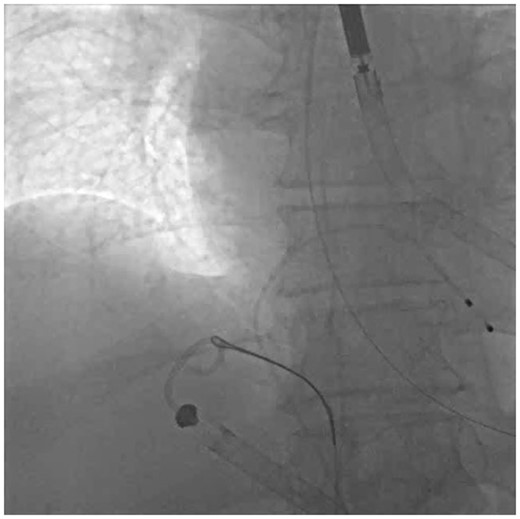 Step 1—Snare: 25 mm GooseNeck snare tightly cinched around the Impella RP pigtail portion in the inferior vena cava–right atrium junction.