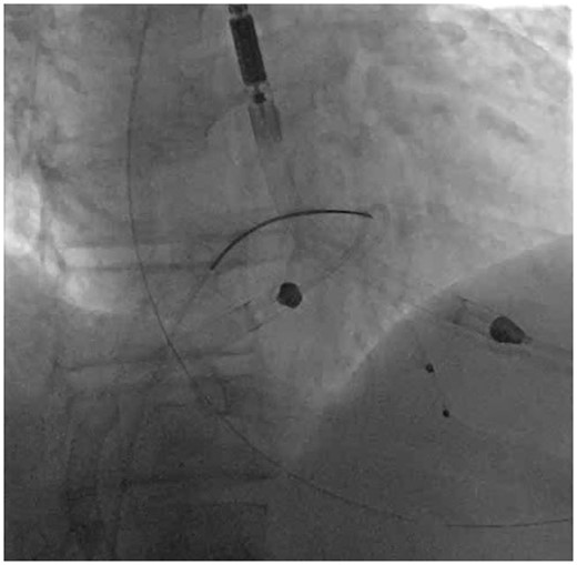 Step 2—Manoeuvre: The snare-guide apparatus and the Impella RP are both manoeuvred across the tricuspid valve and are positioned in the proximal portion of the right ventricular outflow tract.