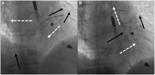 Step 3—Prolapse: (A) Black solid arrows demonstrate the vector forces with continued pushing from the femoral vein and the white dashed arrows demonstrate the motion vectors that the Impella RP-SGA will follow due to the natural course of the right ventricular outflow tract and the geometry of the Impella RP; continued pushing results in the main body of the Impella RP being pushed back into the right atrium and the pigtail portion falling out of the right ventricular outflow tract and into the right ventricle due to opposing vectors of force and motion. (B) After prolapse of the snare-guide apparatus across the pulmonic valve, the vector forces (black solid arrows) now change as the tip of the snare-guide apparatus is now facing 180° in opposition to the path of motion which results in pulling of the Impella RP up into the pulmonary artery while pushing the Impella RP and the snare-guide apparatus from the femoral position, thus creating parallel vectors of force and motion (white dashed arrows).