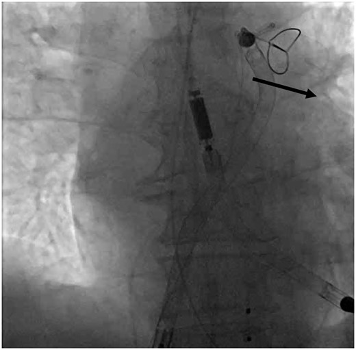 Snare disengagement with black solid arrow demonstrating the direction in which the snare should be advanced after releasing to help facilitate recapture and withdrawal.