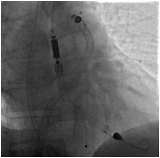 The final correct position of the Impella RP and Impella 5.0 catheters on fluoroscopy.