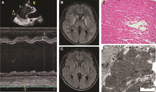 An echocardiographic image (A), magnetic resonance images of the brain (B, C), a histopathological image of the myocardium (D, haematoxylin-eosin stain), and an electron microscopic image of the myocardium (E), at the time of the first admission for heart failure.