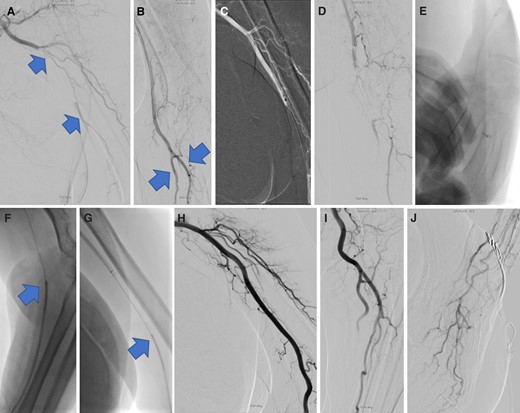 Digital subtraction angiography confirmed occlusion of the brachial artery (arrows in A) with slow flow reconstitution in the ulnar and radial arteries (arrows in B). Rotarex 6F thrombectomy was used (C), resulting in thrombus resolution in the brachial artery but leading to distal embolization and occlusion of the radial and ulnar arteries (D). Distal radial puncture, and insertion of a 5F sheath was subsequently performed (E), facilitating retrograde 5F Envoy catheter aspiration (F and G). This led to complete flow restoration in both the radial and ulnar arteries of the patient (H–J).