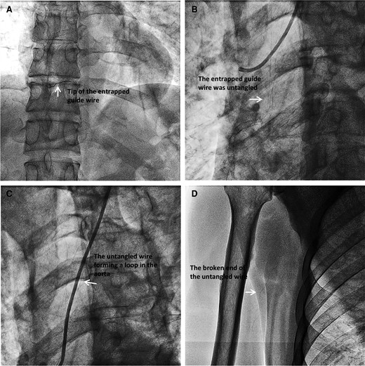 Entrapped guidewire. (A). Guidewire entrapped in RCA; (B). The entrapped guidewire was broken and untangled; (C). The untangled wire was forming a loop in ascending aorta; (D). The broken end of the untangled wire in the right brachial artery.