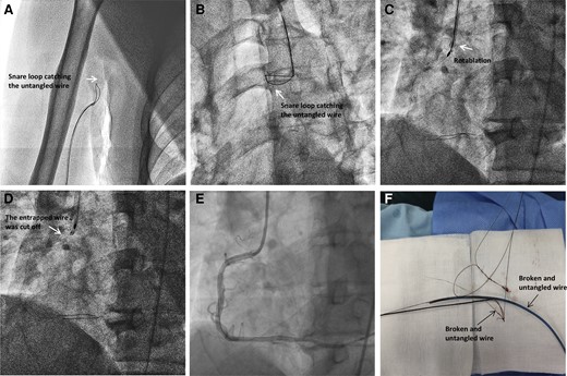 Retrieval of the fractured guidewire. (A). Snare loop catching the untangled guidewire in the right radial artery; (B). Another snare catching the untangled guidewire in the ascending aorta through the left radial approach; (C). Rotablation to cut the guidewire at the ostium of RCA; (D). The entrapped wire was cut off. (E). The entrapped guidewire remnants were jailed under the stent; (F). The retrieved broken guidewire.