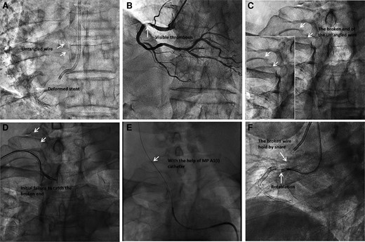 The entrapped guidewire. (A–B). The proximal right coronary stent was longitudinally compressed and had visible thrombosis. (C). The broken end of untangled guide wire in the right carotid artery. (D). The initial attempts to catch the broken end through right radial approach ended in failure. (E). With the help of MP A1(I) catheter, the broken end was caught by a snare through femoral approach. (F). The untangled guidewire was cut off at the ostium of RCA using rotablation.